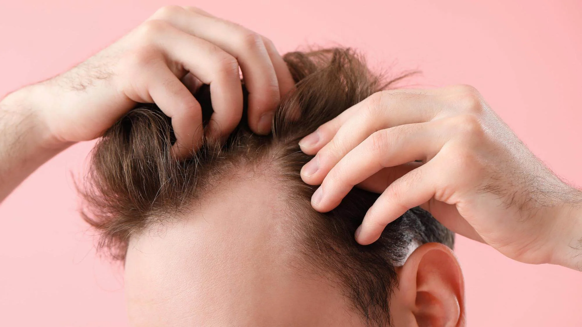 Hair Transplantation in Turkey